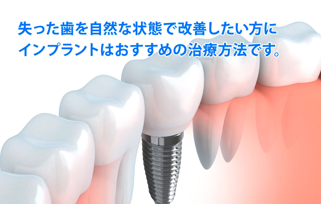 インプラント